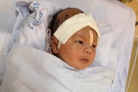 Nguyên nhân bé bị dao đâm xuyên não viêm màng não mủ