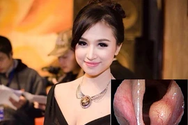 U thanh quản lành tính như MC Thanh Vân có chữa được không?