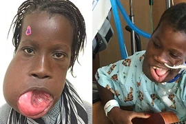 Cô gái có khối u khổng lồ che kín miệng suốt nhiều năm