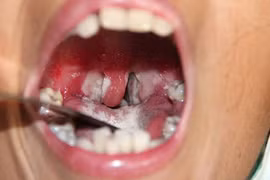 Những lần bệnh bạch hầu hoành hành ở nước ta