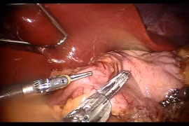 Lần đầu tiên phẫu thuật ung thư dạ dày bằng rô bốt