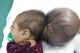 Cắt bỏ đầu thừa cho bé 2 tháng tuổi