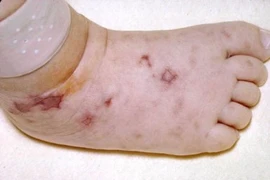  Biến chứng kinh hoàng của viêm màng não mô cầu