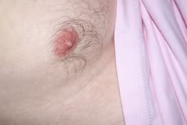 Dấu hiệu cảnh báo sớm ung thư vú ở nam giới