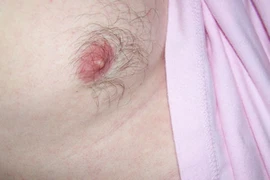 Dấu hiệu cảnh báo sớm ung thư vú ở nam giới