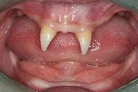 Điểm mặt những ca mọc răng "quái đản" nhất thế giới
