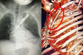 Cứu sống bệnh nhân bị dao đâm xuyên ngực thủng phổi 