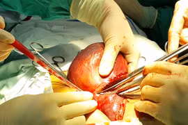 Phẫu thuật khối u lành tính có thể gây chết người?