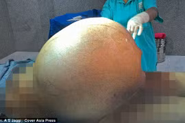 Sốc: Khối u buồng trứng 97kg trong cơ thể bệnh nhân