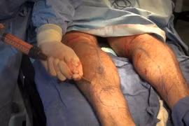 Rùng rợn phẫu thuật xẻo cơ bắp, cắt ngón chân làm đẹp 