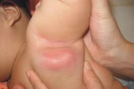 Những phản ứng khi tiêm vắc xin ở trẻ rất nên biết