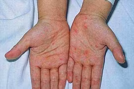 Dấu hiệu nhận biết sớm bệnh sốt xuất huyết