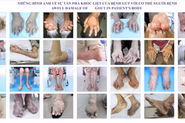 Bệnh gút kèm đái tháo đường, xơ gan cổ trướng, suy thận mạn có thể được quản lý tốt 