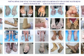 Bệnh gút kèm đái tháo đường, xơ gan cổ trướng, suy thận mạn có thể được quản lý tốt 