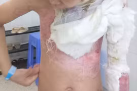 TP HCM: Liên tiếp hai trẻ nhỏ bị bỏng do cồn và xăng