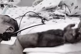 Mắc võng vào máy may, bé mới sinh bị máy ngã đè gãy xương cánh tay
