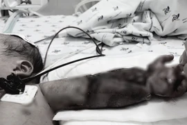 Mắc võng vào máy may, bé mới sinh bị máy ngã đè gãy xương cánh tay