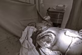 U vú lớn dần, sưng đỏ, loét: Cẩn thận ung thư vú