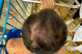 Biết gì về bệnh Rowell hiếm gặp khiến bệnh nhân lở loét toàn thân?