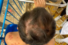 Biết gì về bệnh Rowell hiếm gặp khiến bệnh nhân lở loét toàn thân?