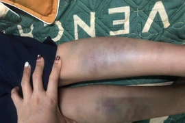  Đà Nẵng: Diễn biến mới vụ học sinh lớp 1 bị đánh bầm tím 