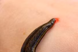 Con đỉa dài hơn 10cm 'ngụ' trong mũi nhân viên bảo rệ rừng ở Quảng Nam cả tháng 