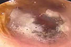 Đau tai đi khám, bác sĩ phát hiện thứ khó tin trong ống tai
