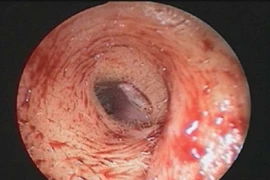 Kinh hoàng ấu trùng Larva trong ống tai