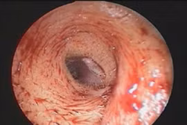 Kinh hoàng ấu trùng Larva trong ống tai