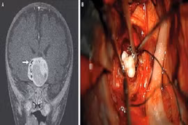 Kỳ lạ răng người xuất hiện trong não trẻ sơ sinh