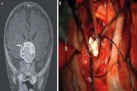 Kỳ lạ răng người xuất hiện trong não trẻ sơ sinh
