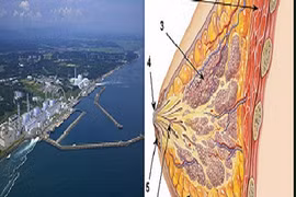 Phóng xạ tại Nhật tăng khả năng gây ung thư vú