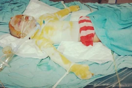 Xót xa hoàn cảnh bé gái 5 tuổi bị bỏng nặng