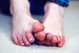 Tay chân lạnh là dấu hiệu nhiều bệnh nguy hiểm