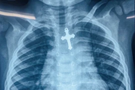 Bé trai 3 tuổi nguy kịch vì nuốt cây thánh giá vào thực quản