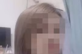 Người phụ nữ mặt trắng bệnh, co giật rồi chết não khi cấy ghép mỡ để làm đẹp