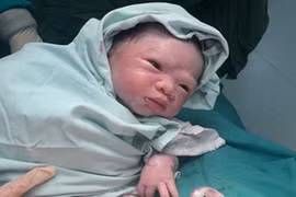 Hy hữu trường hợp thai nhi bị dây rốn cuốn 2 vòng cổ ở Tuyên Quang