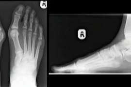 Hình ảnh 3D bàn chân chấn thương do đi giày cao gót