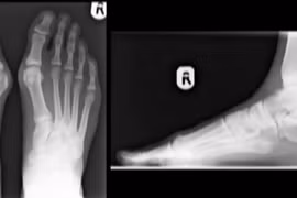 Hình ảnh 3D bàn chân chấn thương do đi giày cao gót