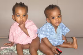 Tách rời bé song sinh dính liền xương sống