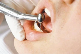 Cận cảnh khoan răng, đính đá làm đẹp