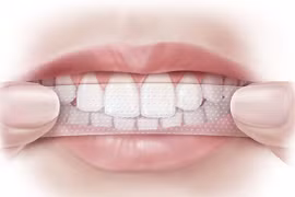 Hậu họa khôn lường từ miếng dán trắng tẩy răng