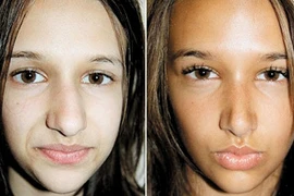 Cơn sốt phẫu thuật thẩm mỹ của “teen”
