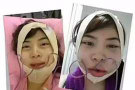 Hành trình gọt mặt đau đớn của gái trẻ 