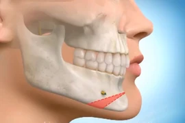 Zoom cận cảnh phẫu thuật chỉnh cằm, gọt mặt