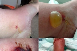 Suýt bị liệt vì nhện độc cắn