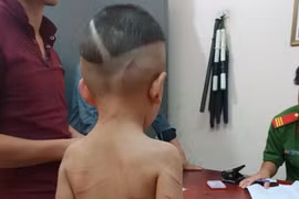 Phẫn nộ cha dượng bạo hành con riêng vợ bằng thắt lưng, móc áo