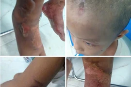 Bé 6 tuổi trên người chi chít vết bỏng nghi bị cha ruột bạo hành