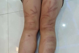 Nhiều trẻ mầm non bị đánh bầm tím cơ thể tại lớp học