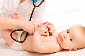 Các giai đoạn phát triển của bệnh thủy đậu